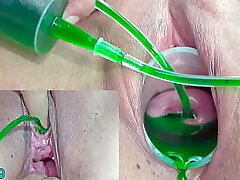 Cervix and Piss Hole Inflation with Insertions for Japanese Lesbos